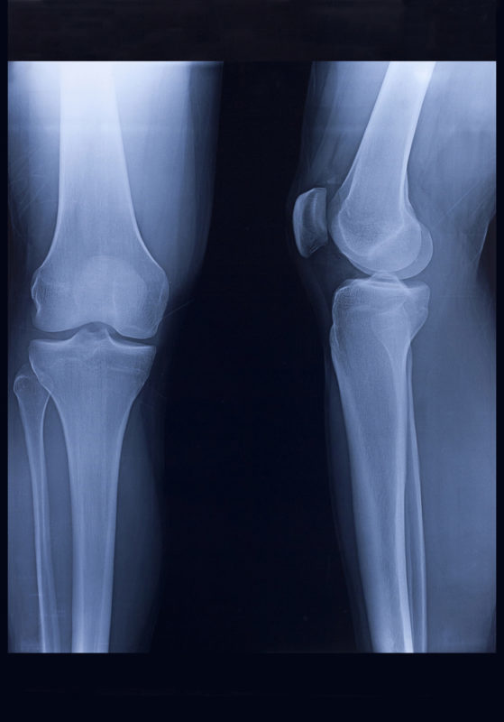 X-Ray, Knee